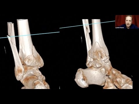 Posterior malleolus and beyond - BOFAS Lecture of Distinction - Lyndon Mason and Andy Molloy