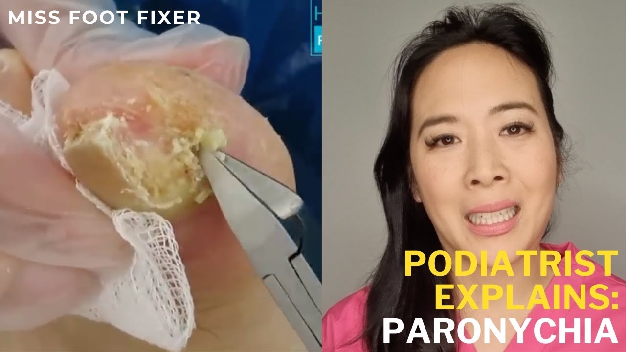 Emergency Nail Infection Treatment: Quick Paronychia Relief While Traveling | Miss Foot Fixer