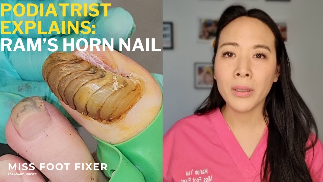 What is RAM's HORN NAIL?