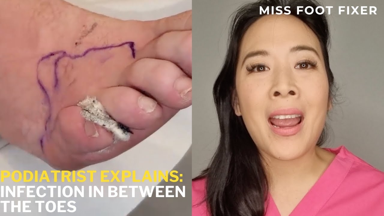 Prevent Dangerous Toe Infections & Cellulitis: Quick Fixes & Why Moisture Matters! | Miss Foot Fixer