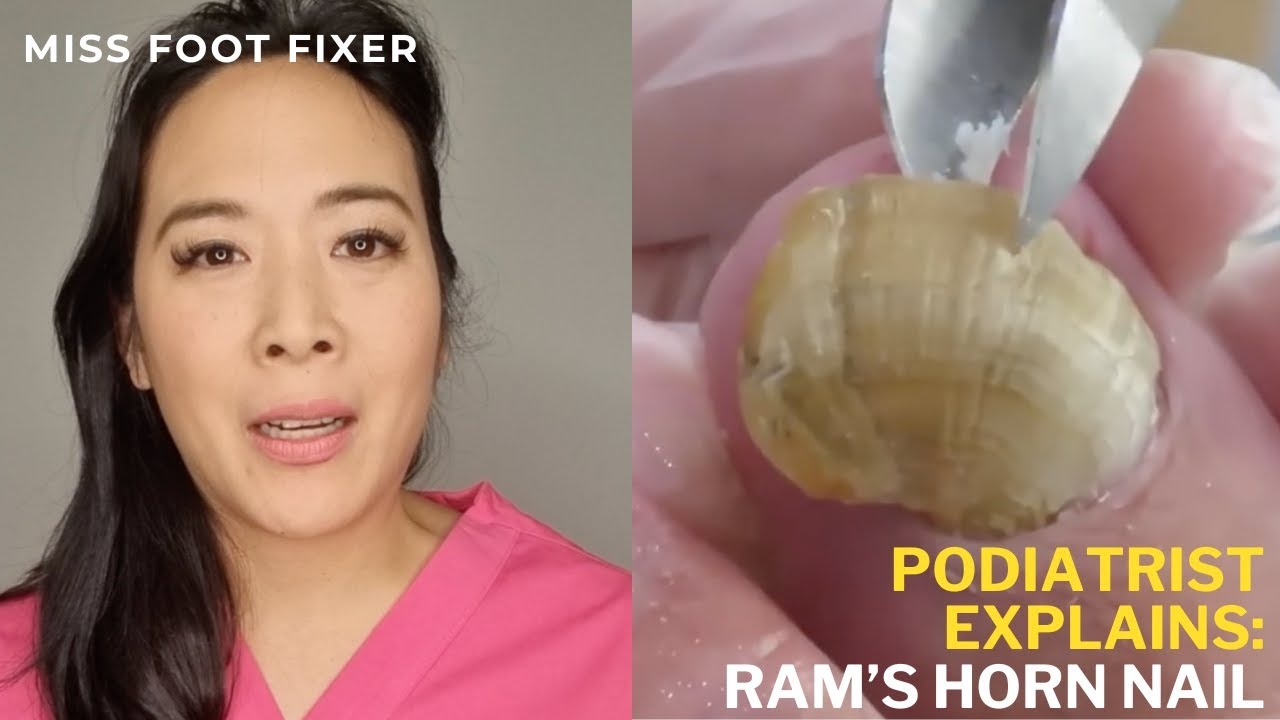RAMS HORN TOENAILS | Trimming Extremely Long and Thick Toenails | Toenail Fungus | Miss Foot Fixer
