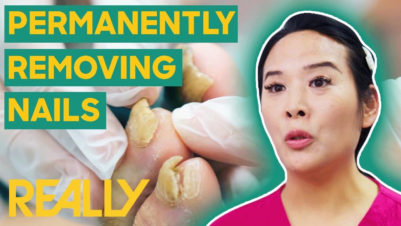 Podiatrist Marion Performs Permanent Nail Removal | The Bad Foot Clinic | Brand New Series