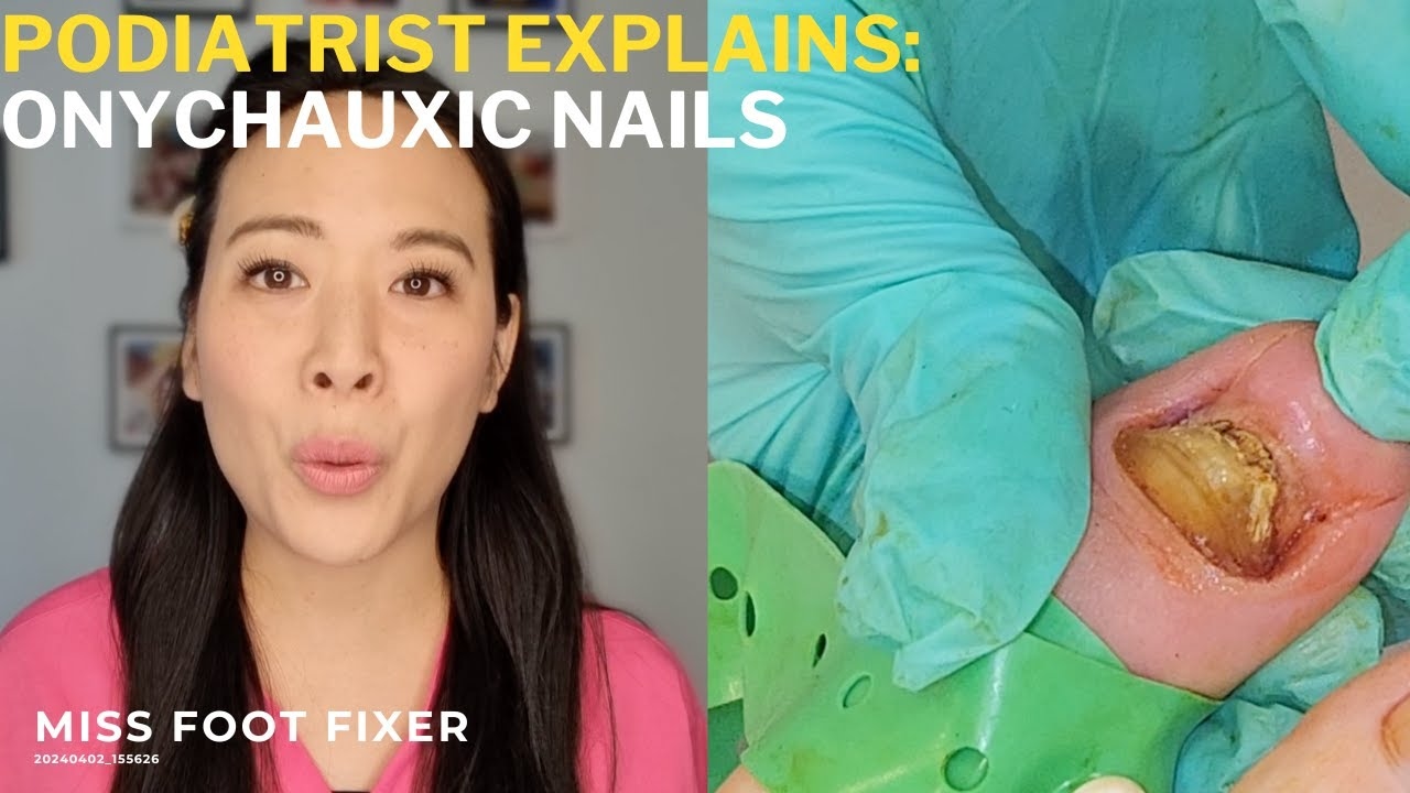 Podiatrist Explains: ONYCHAUXIC NAILS